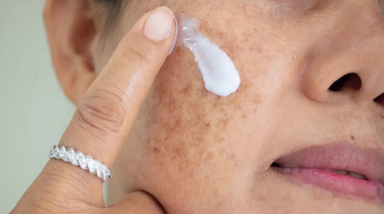 melhor pomada para melasma