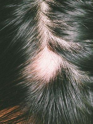 Alop&eacute;cia Areata