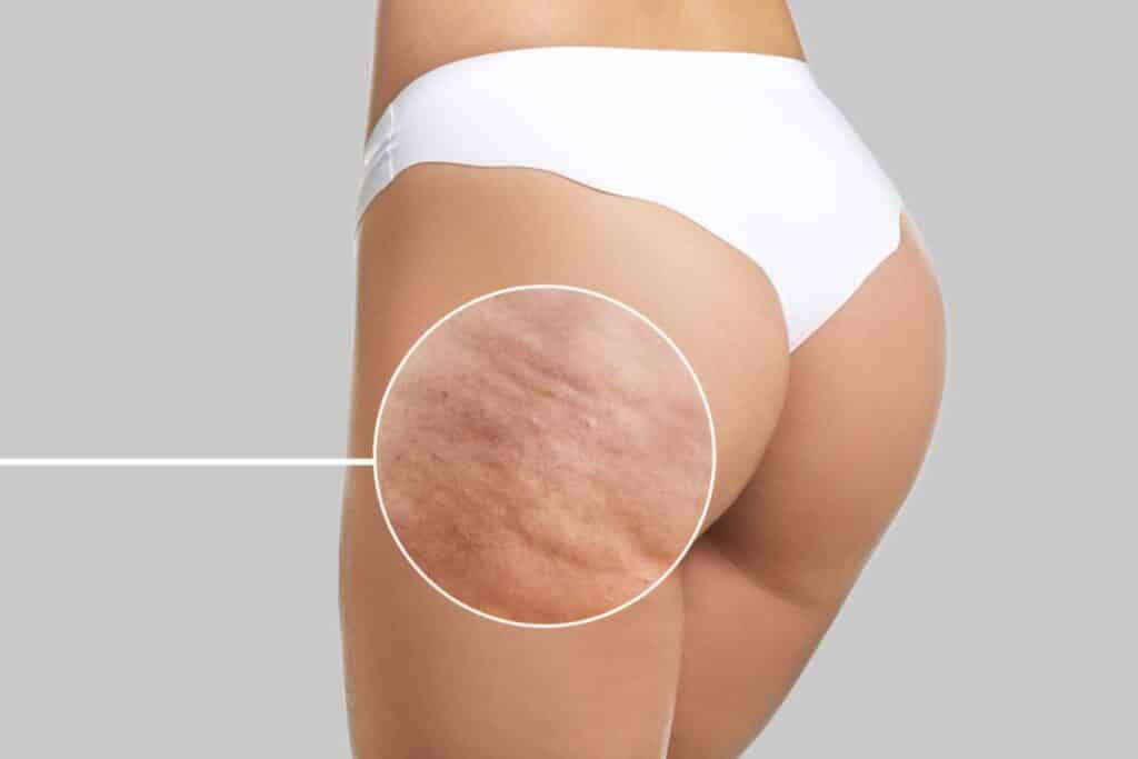 Coxa de uma paciente com celulite visível, antes do tratamento
