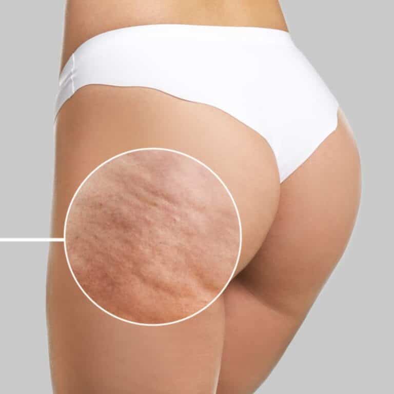 Celulites