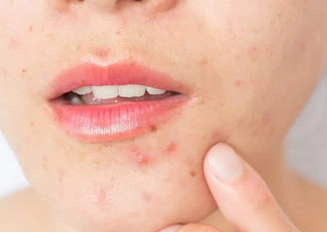 acne Dermatologia clínica