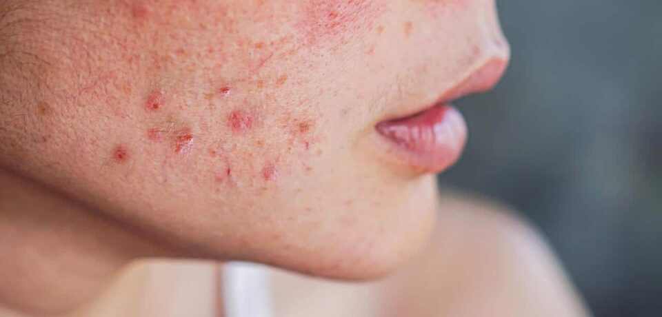 o-que-e-rosacea o-que-e-rosacea