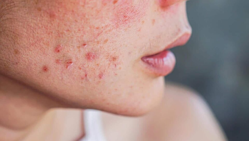 o-que-e-rosacea