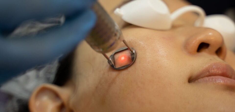 tratamento-de-Melasma tratamento de melasma