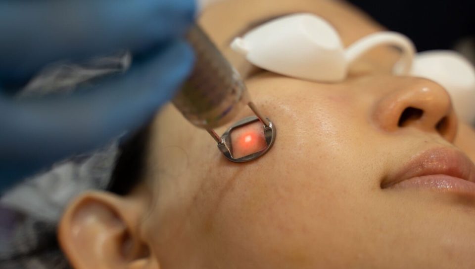 tratamento de melasma