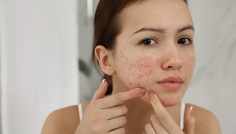 qual o melhor tratamento para acne
