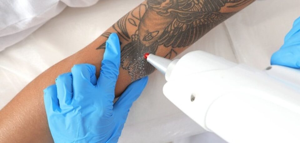 como-remover-tatuagem Pessoa removendo tatuagem com profissional