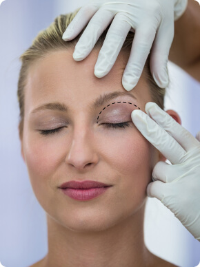 Blefaroplastia Superior