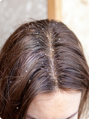 Dermatite seborreica (1)