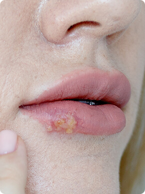 Herpes (1)