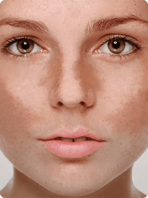 Melasma-1.png