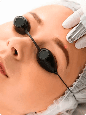 Remo&ccedil;&atilde;o de Micropigmenta&ccedil;&atilde;o