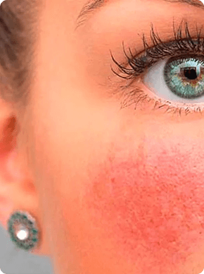 Rosacea.png