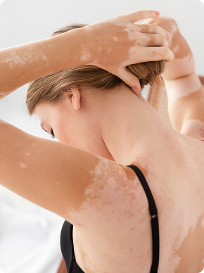 Vitiligo (1)