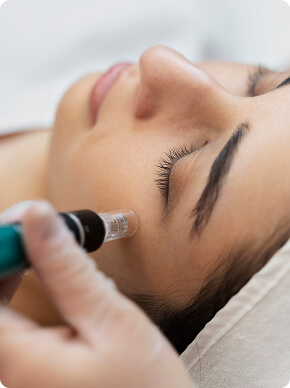 Microagulhamento Eletrônico