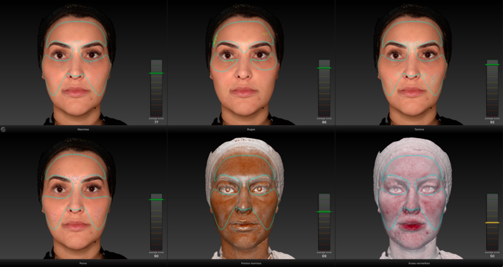 Painel do Vectra H2 com a análise 3D do rosto: manchas, rugas, textura, poros, pontos marrons e áreas vermelhas, cada um com a sua pontuação