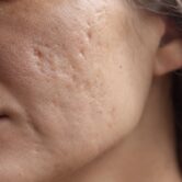 Mulher observando a textura da pele do rosto no espelho antes de iniciar tratamento para cicatriz de acne