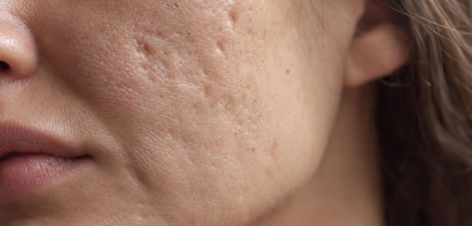 Mulher observando a textura da pele do rosto no espelho antes de iniciar tratamento para cicatriz de acne